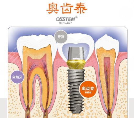 韩国奥齿泰种植牙质量怎么样