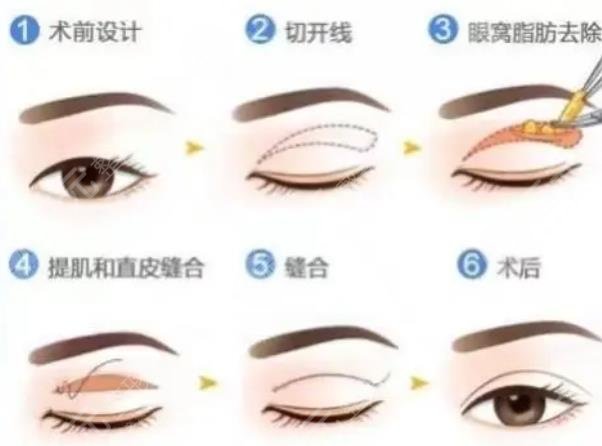 双眼皮整形手术原理