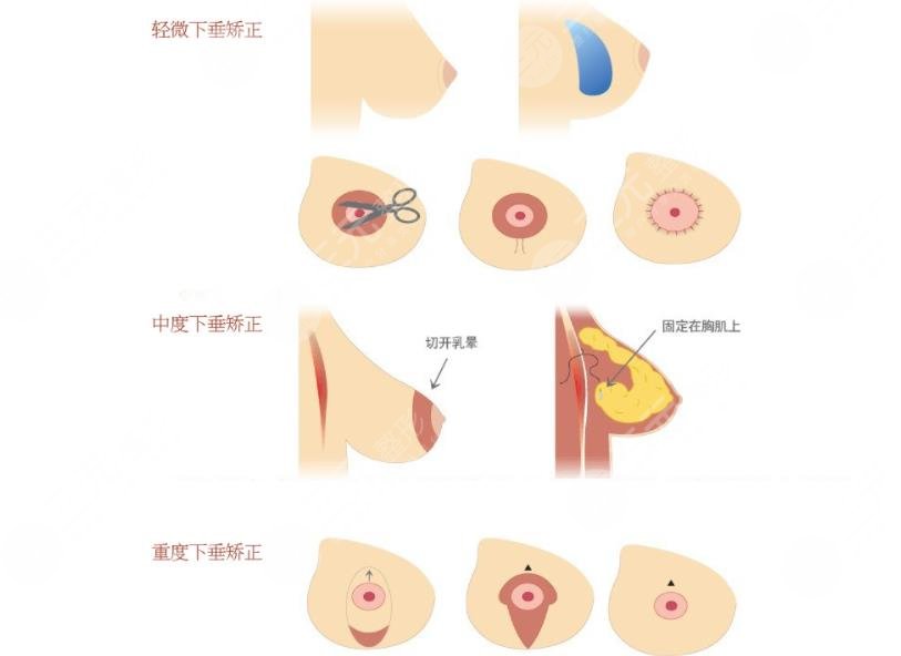 乳房提升棒棒糖切口跟双环切口区别