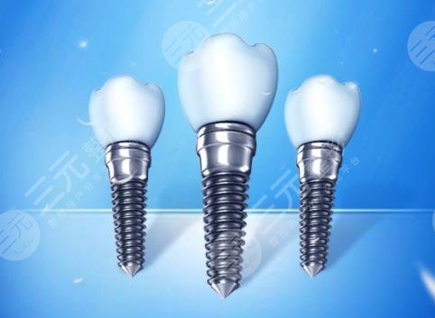 美国的种植牙质量怎么样