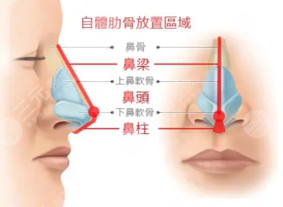 肋骨隆鼻