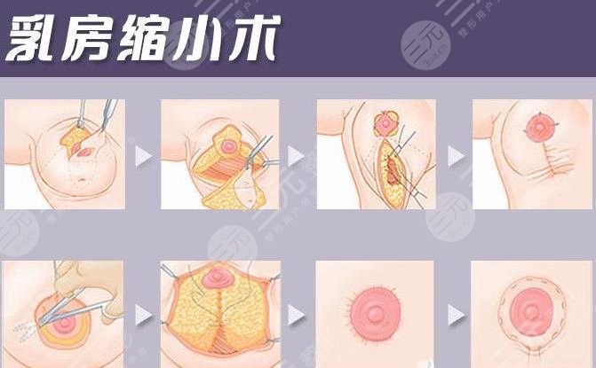 棒棒糖缩胸手术疤痕多久可以恢复