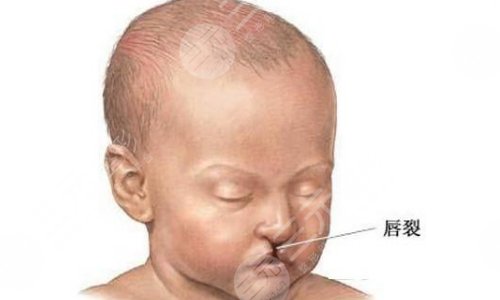 唇腭裂能完全修复好看不到痕迹吗？唇腭裂恢复正常有多难？