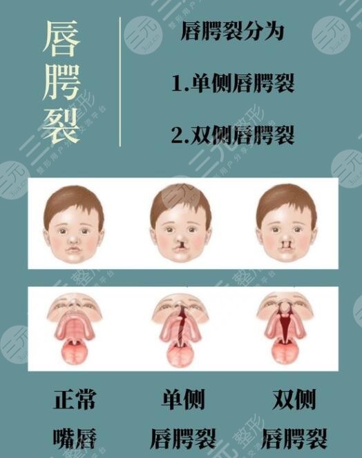 什么是唇腭裂呢