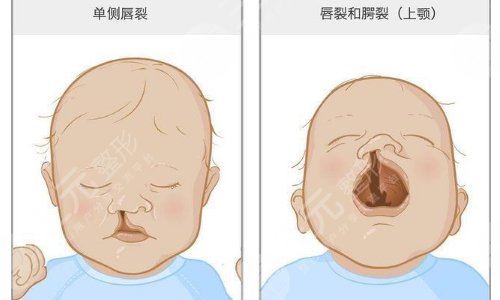 唇腭裂的危害