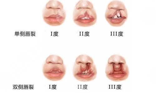 唇腭裂可以完全修复吗
