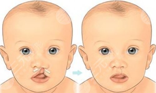 婴儿高腭弓嘴型图片图片