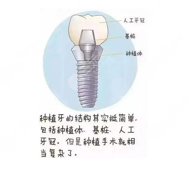 什么是种植牙?多少钱一颗?注意事项大盘点~