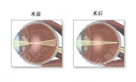 激光治疗近视的危害