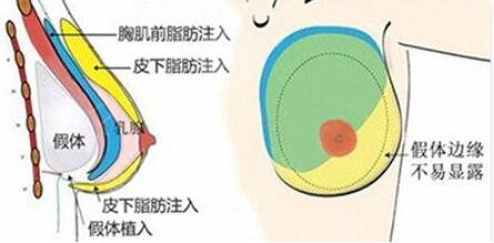 复合隆胸指的是什么