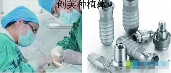 国产种植牙品牌及价格是多少