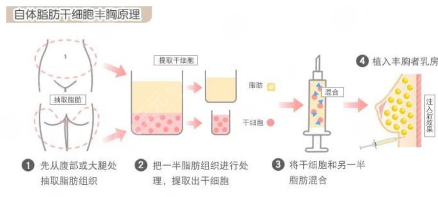 复合隆胸注意事项