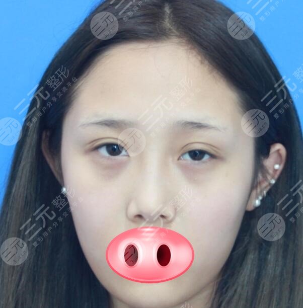 王世勇眼修复术前