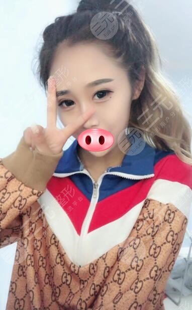 手术后30天