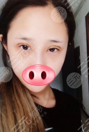 手术后七天