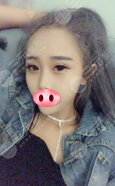 手术后90天