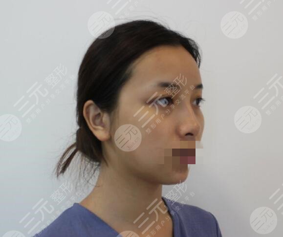 武汉德美热玛吉做得好不好