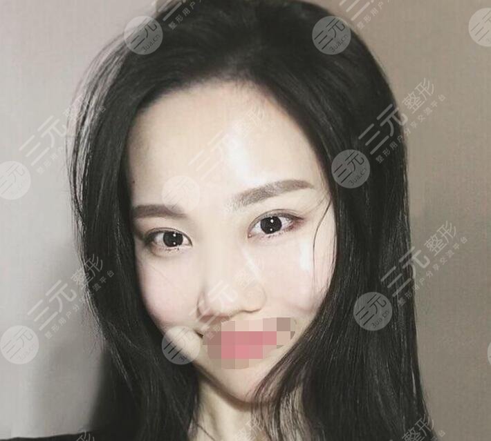 张立宪医生隆鼻案例术前