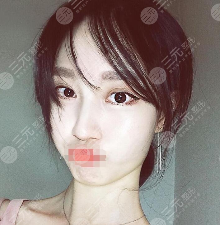 张立宪医生隆鼻案例术后一个月