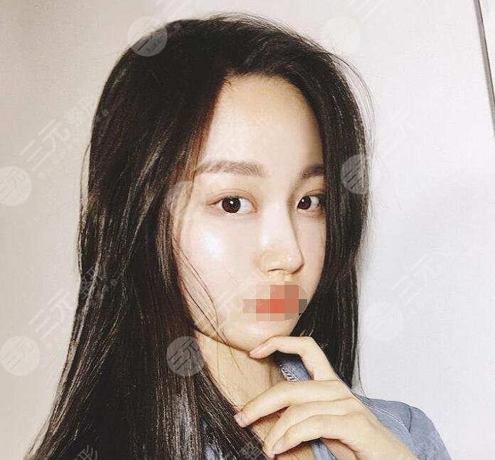 张立宪医生隆鼻案例果