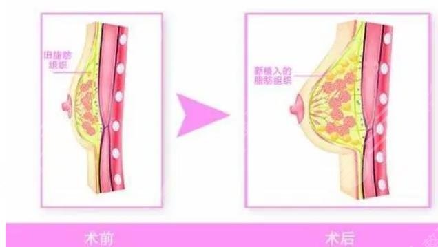 隆胸手术的操作过程