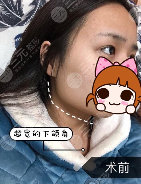 北京张笑天医生磨骨案例：术前
