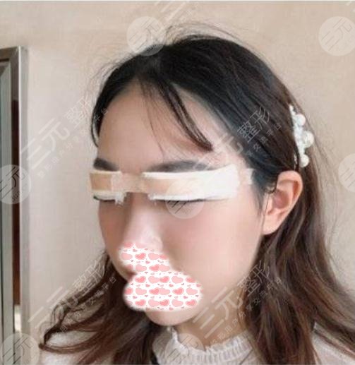 双眼皮案例：手术当天