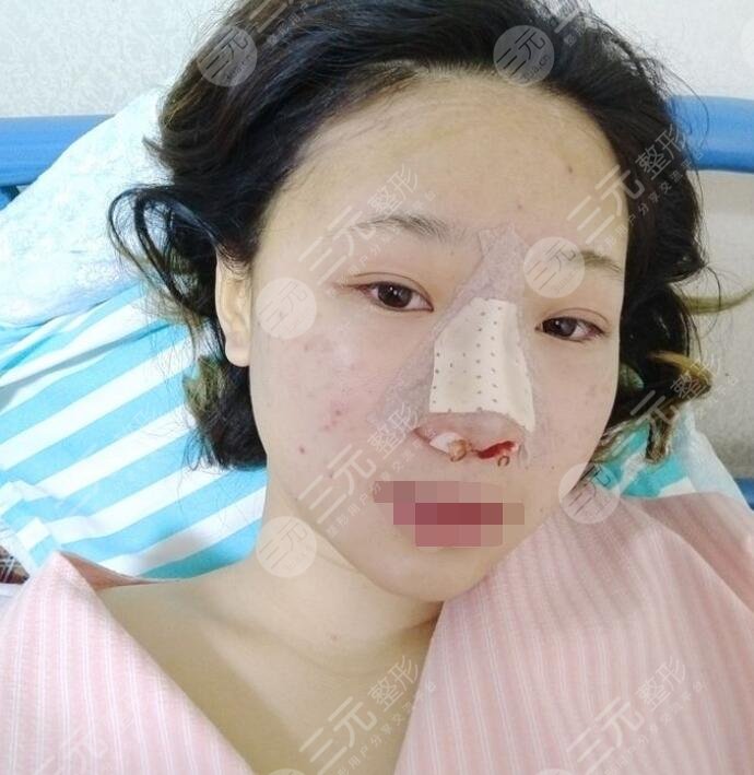 深圳向宏伟医生隆鼻后当天