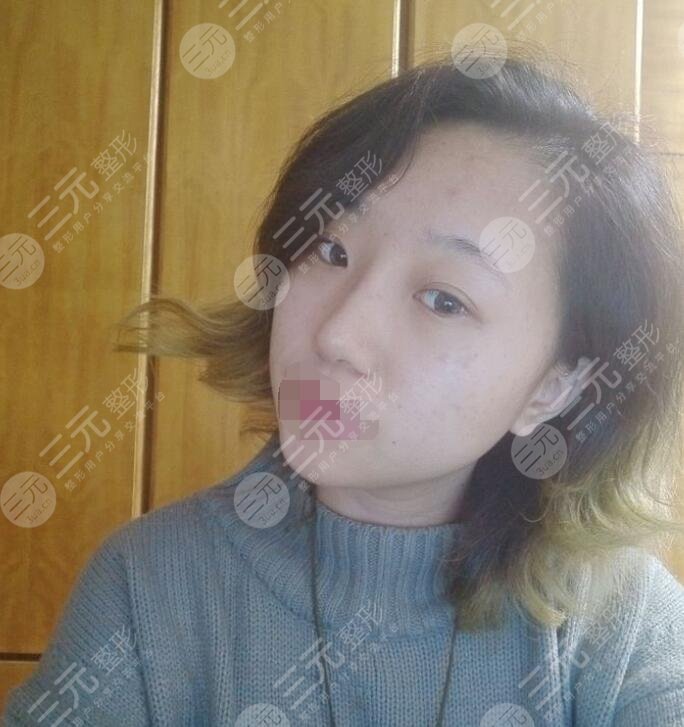 深圳向宏伟医生隆鼻后一个月