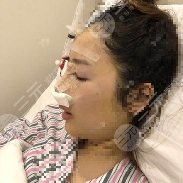 天使之翼做鼻子怎么样