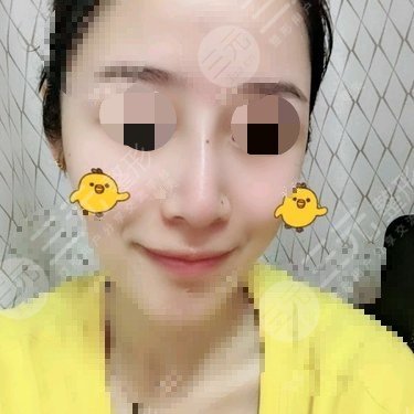 天使之翼做鼻子怎么样