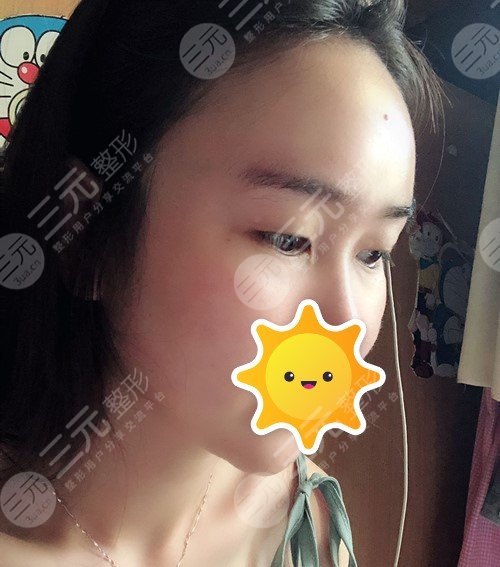 龚忠华医生全切双眼皮前