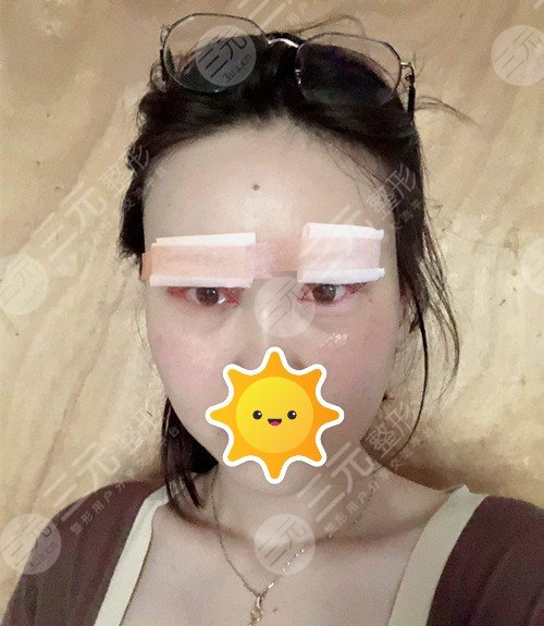 龚忠华医生全切双眼皮后一天