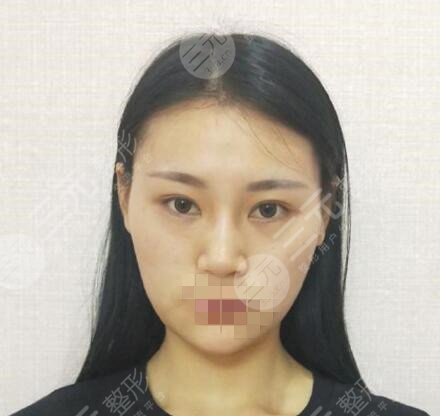 修志夫做鼻子怎么样