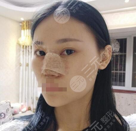修志夫做鼻子怎么样
