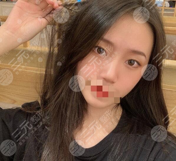 东莞韩美做鼻子日记美图分享