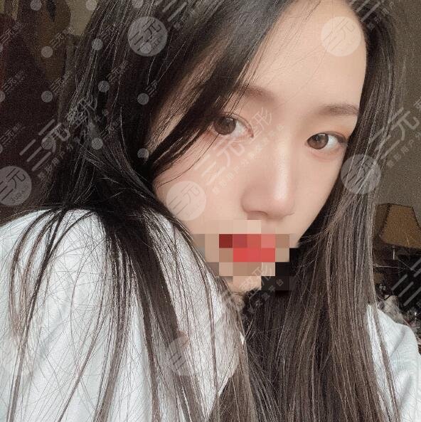 东莞韩美做鼻子日记美图分享