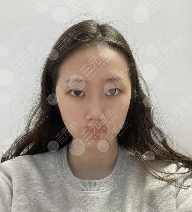 东莞韩美做鼻子日记美图分享