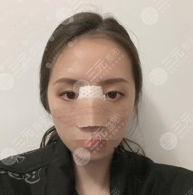 东莞韩美做鼻子日记美图分享
