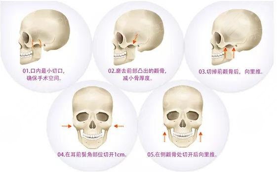 上海颧骨内推一般多少钱