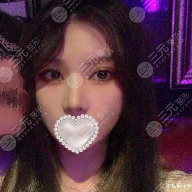 刘彦军隆鼻案例