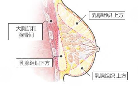 自体脂肪丰胸副作用后遗症