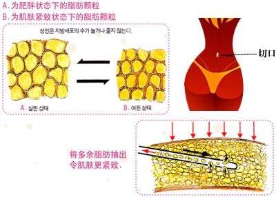 降低风险有的减肥方法，吸脂减肥法