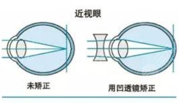 激光近视手术度数范围是多少？激光近视手术的优势有哪些？