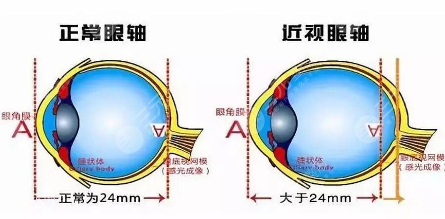 近视的度数范围