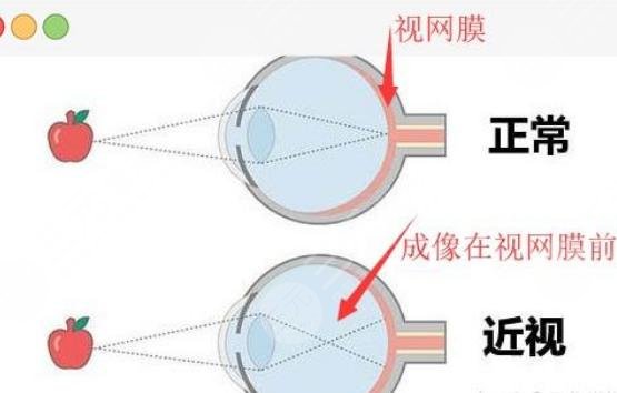 近视手术的要求是什么