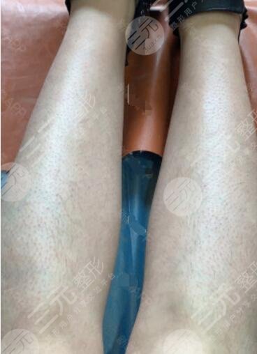深圳瑞尼丝国际脱毛中心