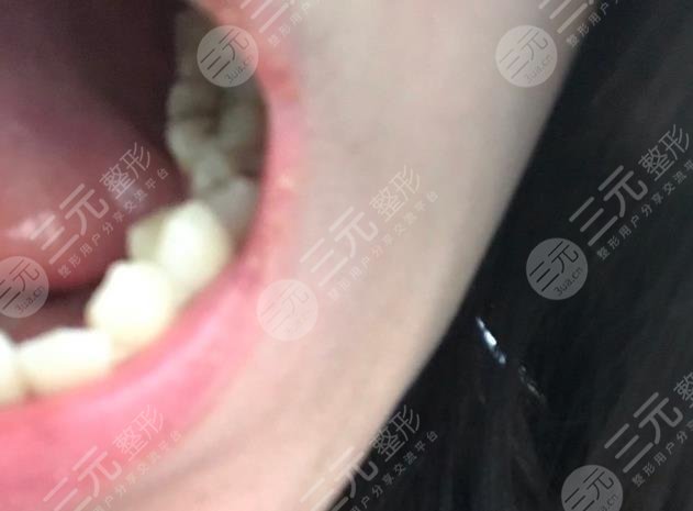 宿州信美口腔医院(淮海中路)牙齿种植经历分享