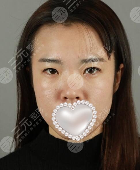 北京渡曼医疗美容诊所双眼皮案例