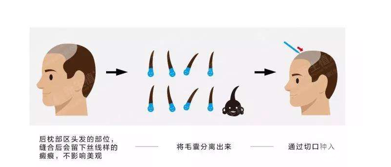5000块可以植发吗